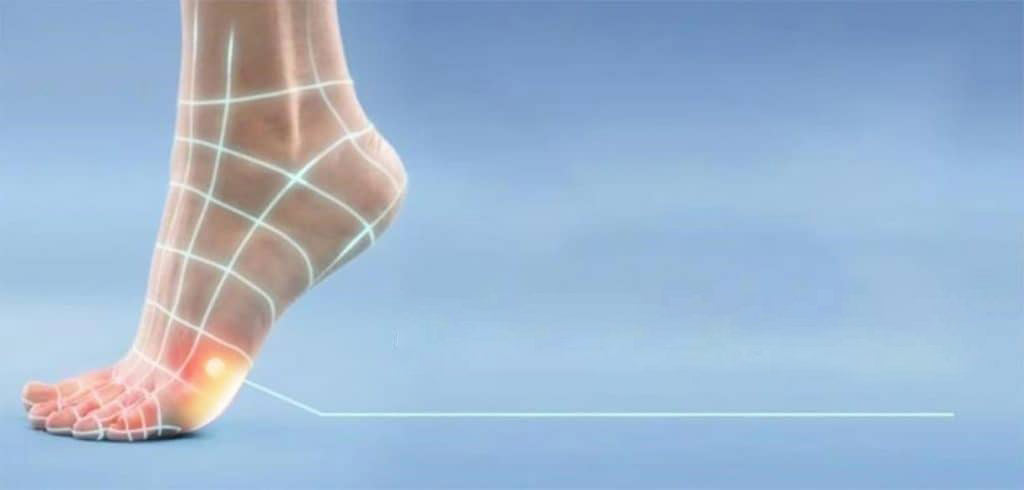 Calluses on Feet – Causes, Signs & Management