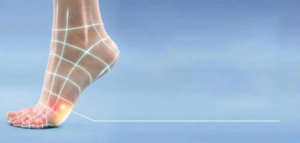 Foot Corns — Causes, Signs, & Treatment